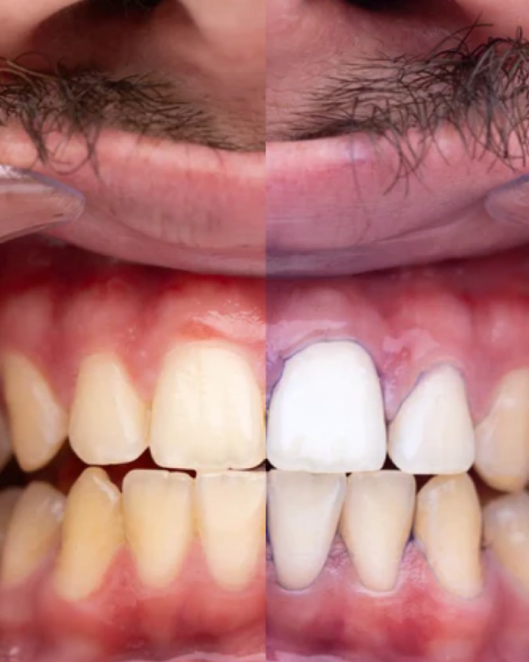 Blanqueador V34 Glumi