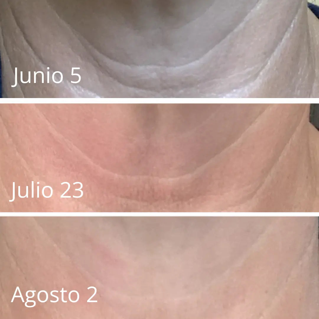Esplenderm Lifting Universal: Efecto Tensor Inmediato en Piel Flácida | Tratamiento No Quirúrgico