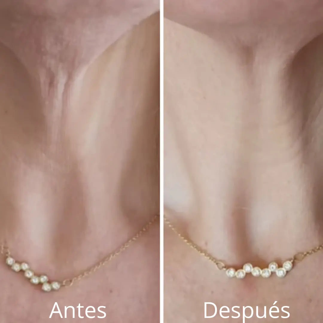 Esplenderm Lifting Universal: Efecto Tensor Inmediato en Piel Flácida | Tratamiento No Quirúrgico